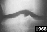 Genou - 1968